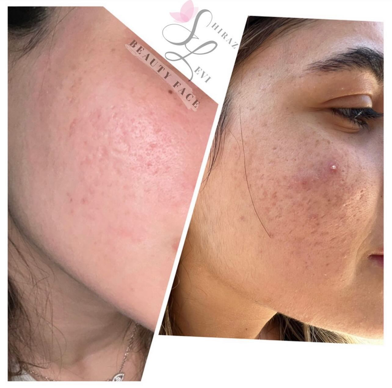 תוצאות טיפול לשיפור מרקם עור הפנים ואקנה - לפני ואחרי
