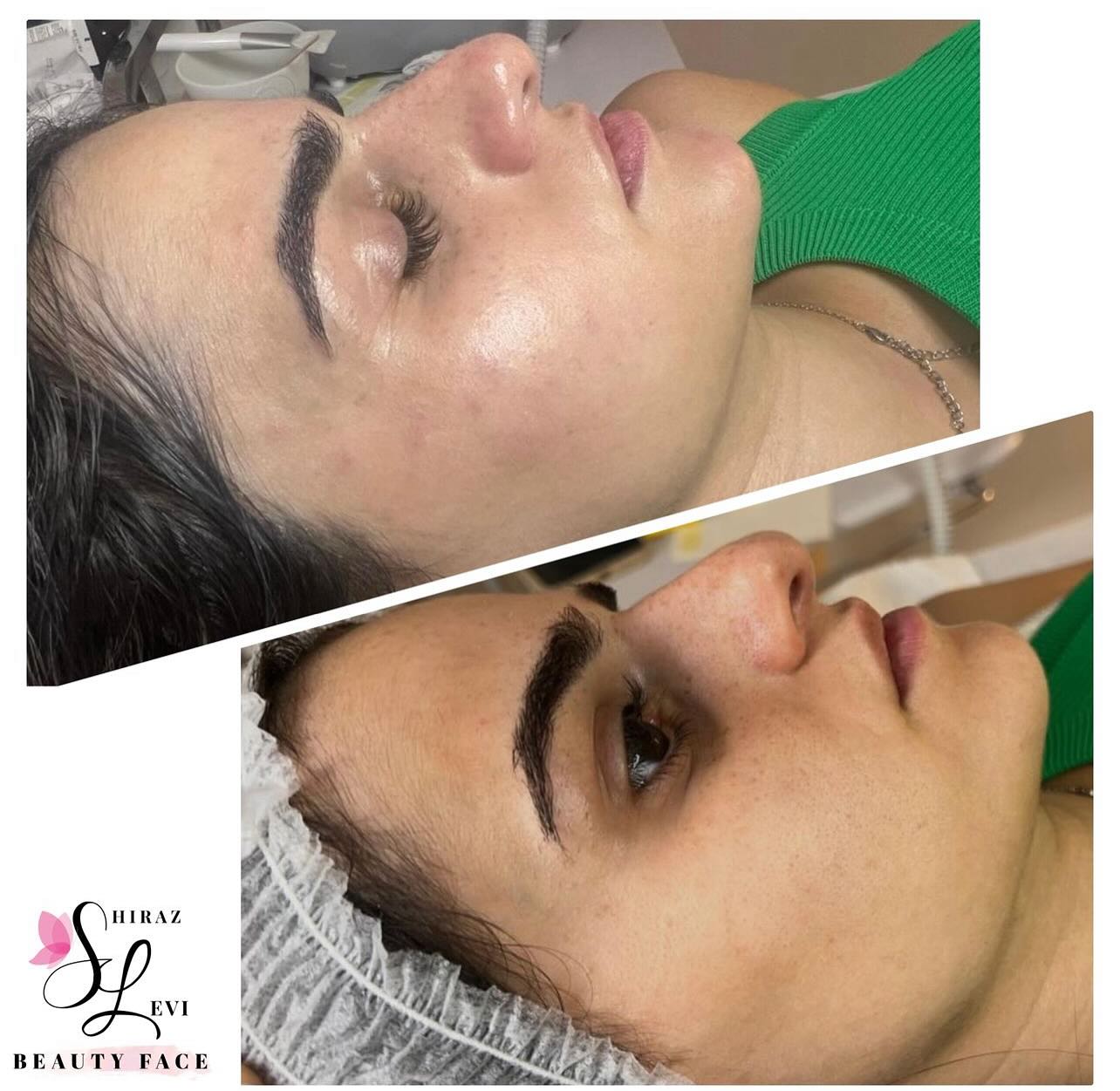 תוצאות טיפול פנים להענקת זוהר ומראה רענן - לפני ואחרי