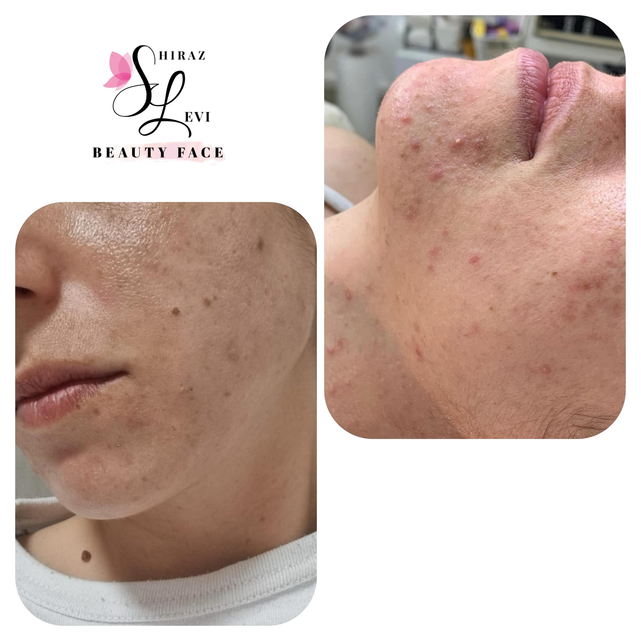 תוצאות טיפול באקנה באזור הסנטר והלסת - לפני ואחרי