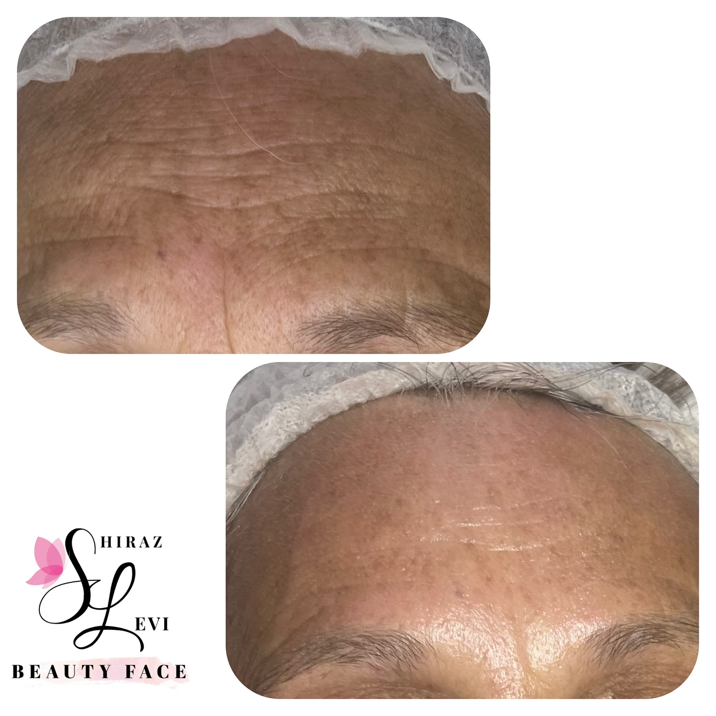 תוצאות טיפול אנטי אייג'ינג להחלקת קמטים במצח - לפני ואחרי