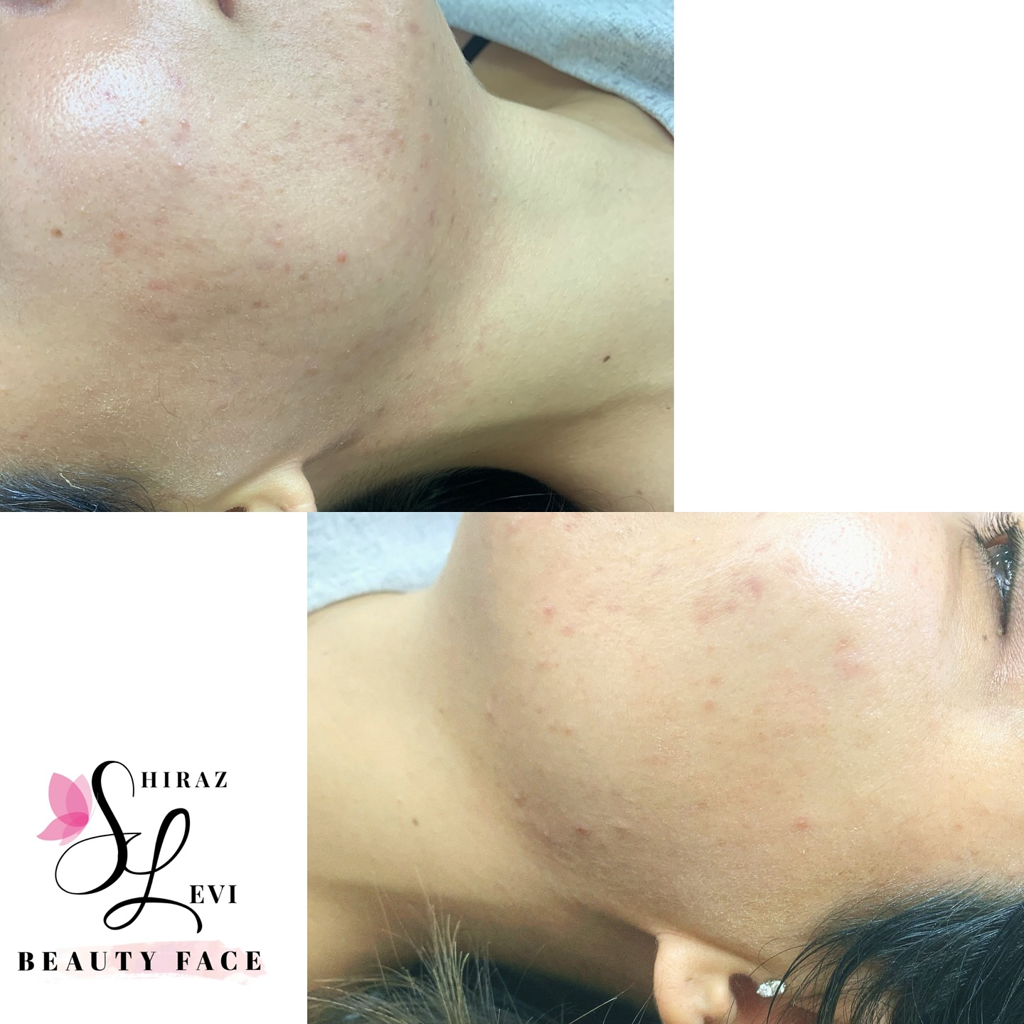 תוצאות טיפול באקנה באזור הלחי והסנטר - לפני ואחרי