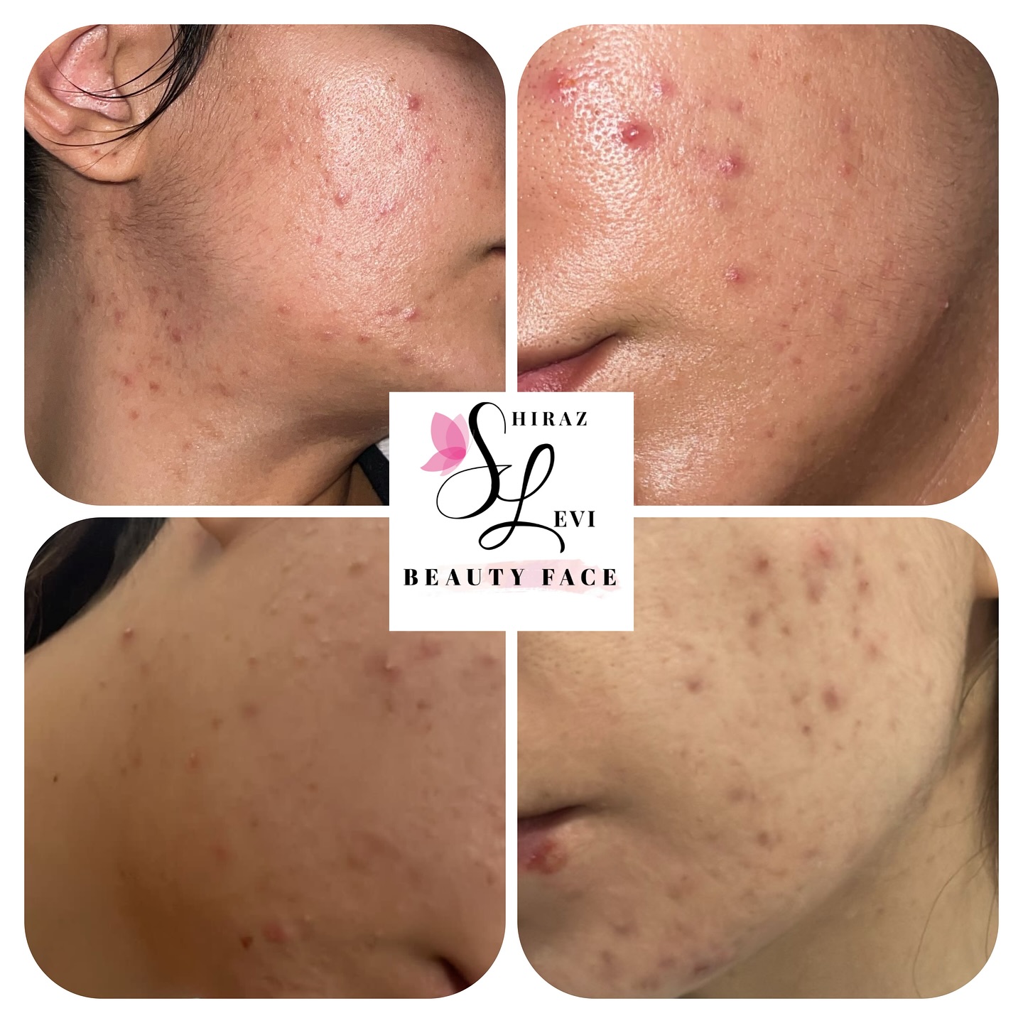תוצאות טיפול באקנה בעור הפנים - ארבעה שלבי שיפור