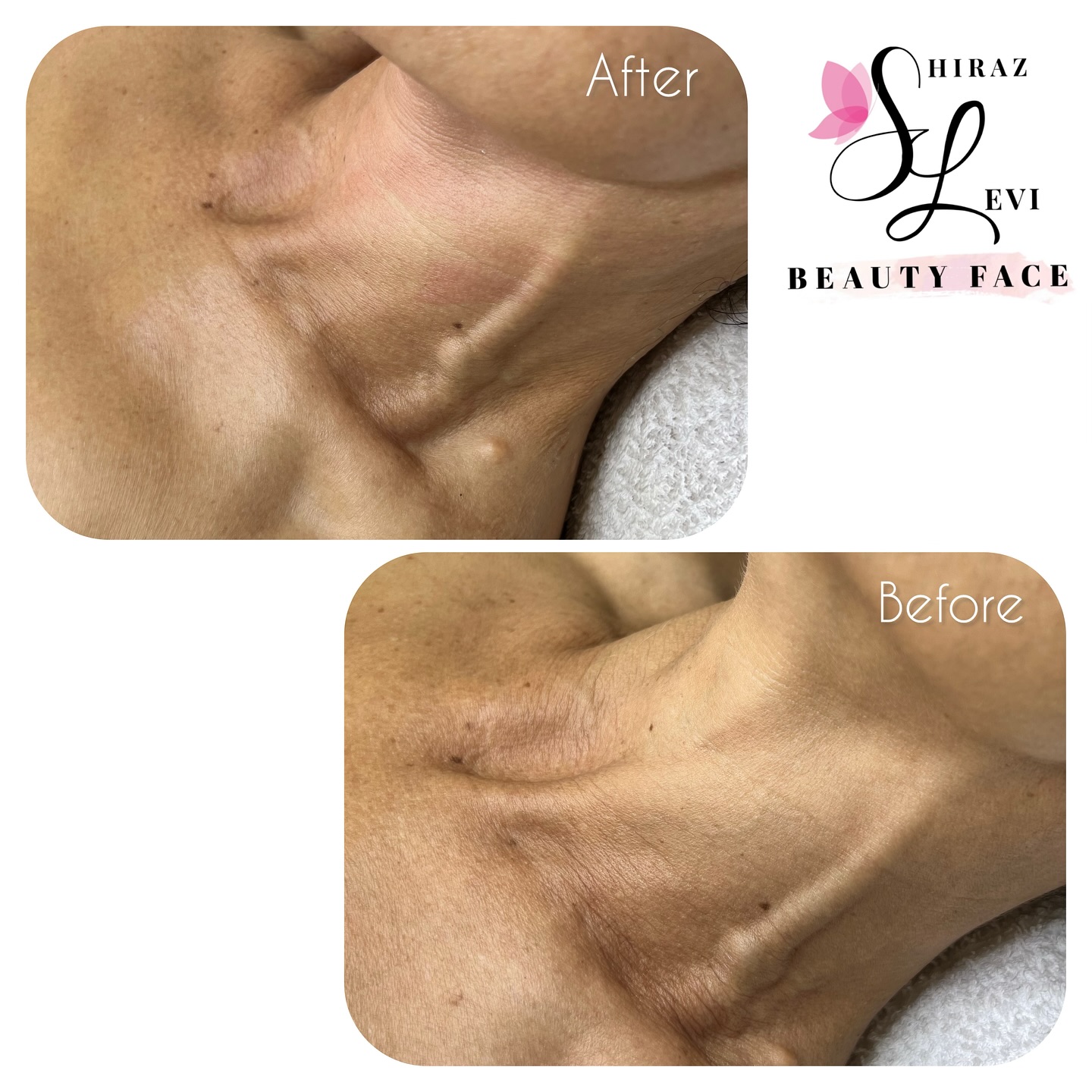 תוצאות טיפול אנטי אייג'ינג באזור הצוואר - לפני ואחרי