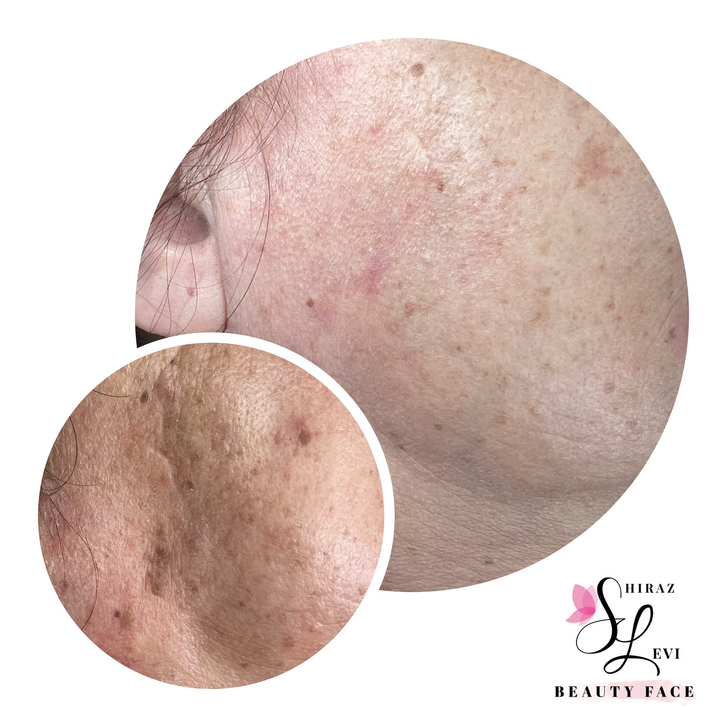 תוצאות טיפול בפיגמנטציה ואקנה בעור הפנים