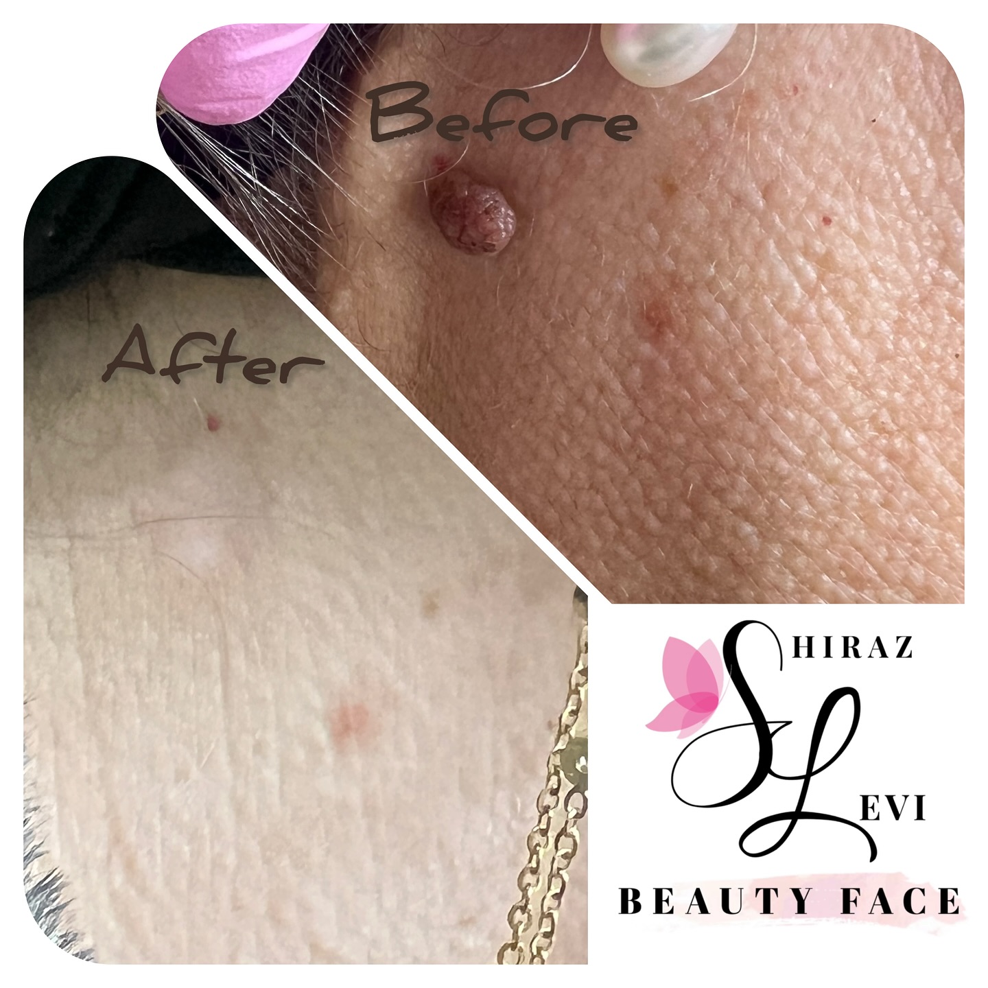 תוצאות הסרת שומה קוסמטית - לפני ואחרי