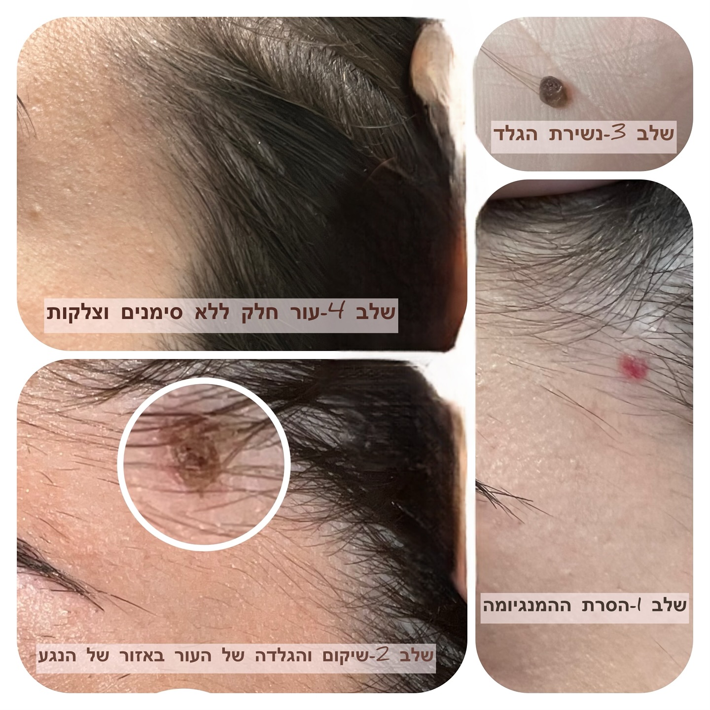 שלבי טיפול להסרת נגע עור ושיקום - ארבעה שלבים