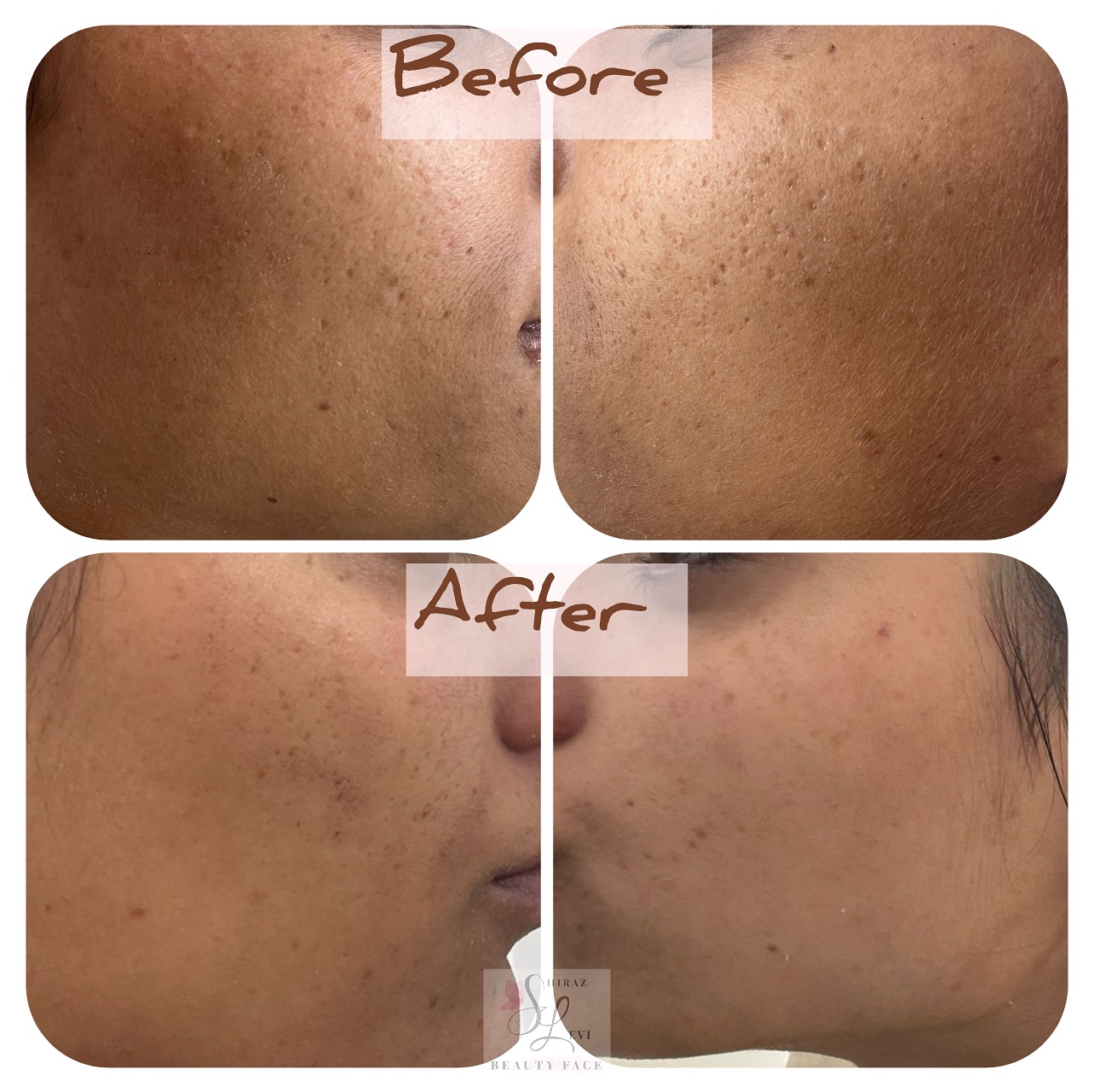 תוצאות טיפול באקנה ושיפור מראה העור - לפני ואחרי