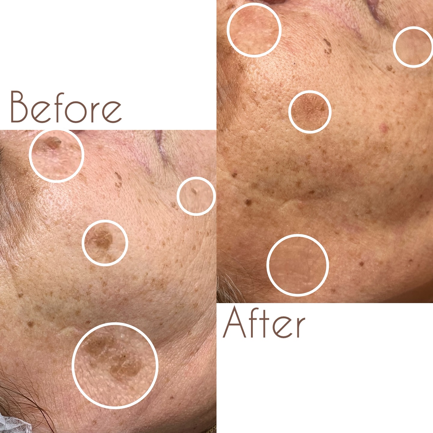 תוצאות טיפול בפיגמנטציה בעור הפנים - לפני ואחרי