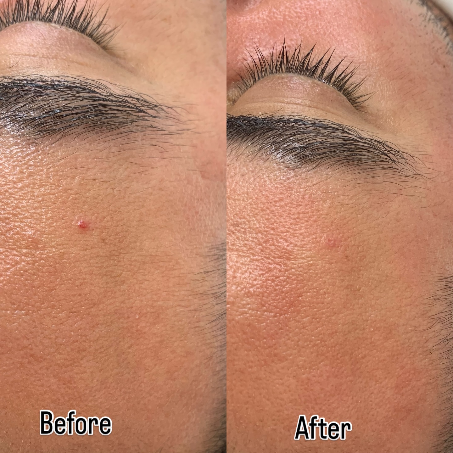 תוצאות טיפול לשיפור מרקם עור הפנים - לפני ואחרי