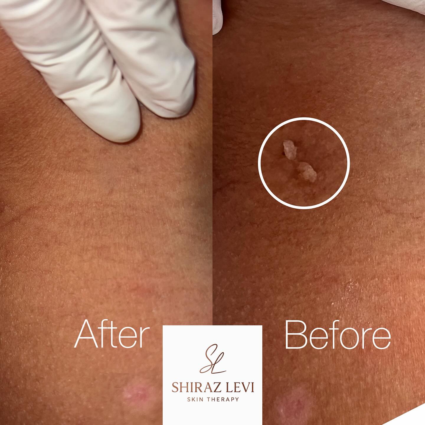 תוצאות הסרת נגעי עור - לפני ואחרי