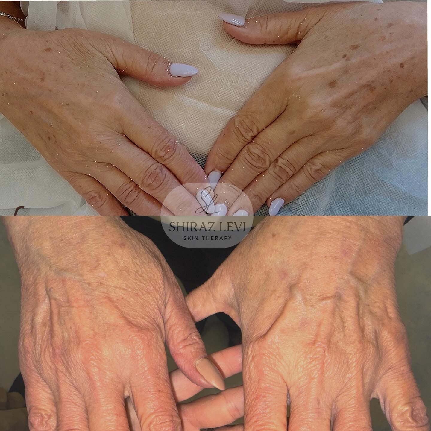 תוצאות טיפול הצערת עור כפות הידיים - לפני ואחרי